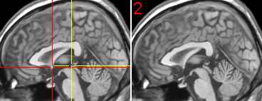 neuroanatomy atlas: the anterior commissure