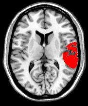 patient 9 lesion